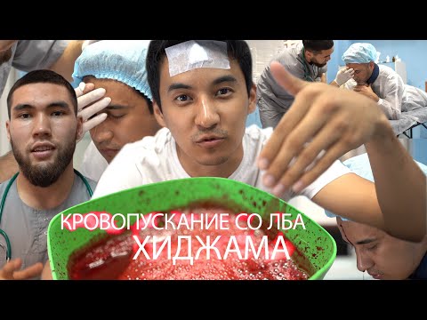 Хиджама, Кровопускание со лба #Казахстан #Актау #Мангистау