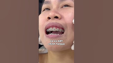 LÒ XO ART CHỈNH TORQUE