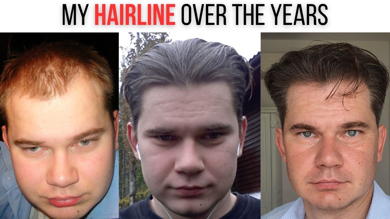 Моя линия роста волос за эти годы — и почему она не всегда идеальна.