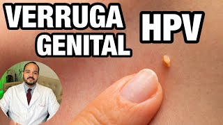 Verrugas Genitais E Em Região Anal - Como Saber Se É Hpv?