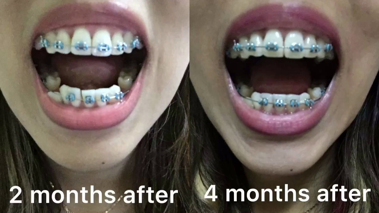 BRACES UPDATE after oral surgery 4 months after 6th 