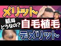 【自毛植毛】「ハゲを治す!」薄毛の専門医が、自毛植毛のメリットとデメリットについて解説します