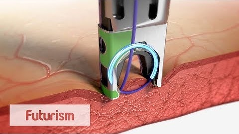 Minimally Invasive Wound Suturing Device