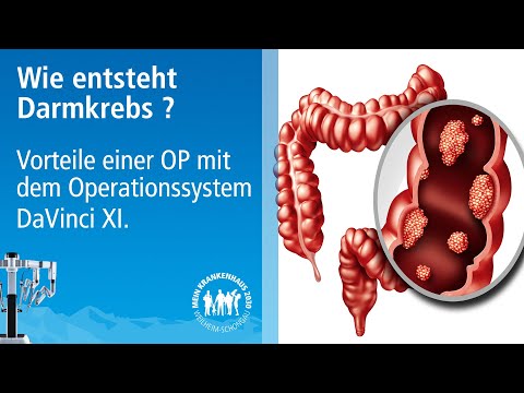 Video: Stuhlinkontinenz Nach Vollständiger Mesorektaler Entfernung Bei Rektumkrebs - Auswirkungen Potenzieller Risikofaktoren Und Intraoperatives Neuromonitoring Des Beckens