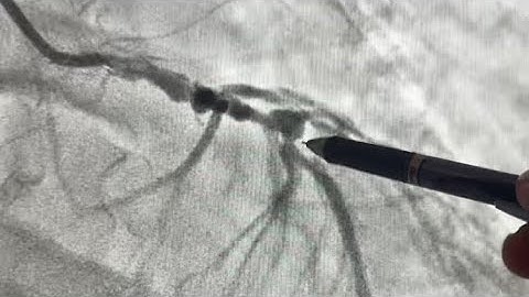 High-Risk LM & LAD PCI: Intravascular Lithotripsy. Full Procedure + Practical Tips! 