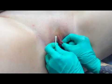 The q-tip test for VCH (vertical hood) piercing suitability