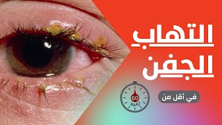 التهاب الجفن في أقل من 60 ثانية