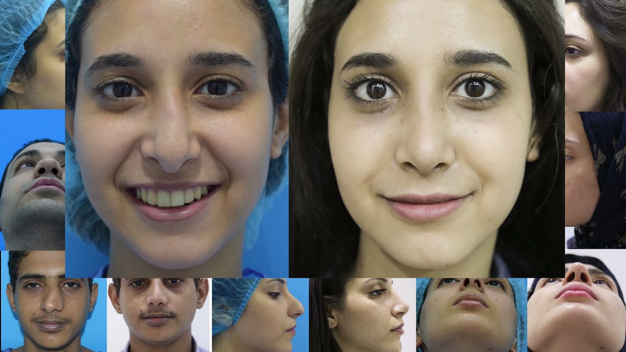 نتائج لبعض عمليات تجميل الأنف البروفسور الدكتور حسام أبو العطا