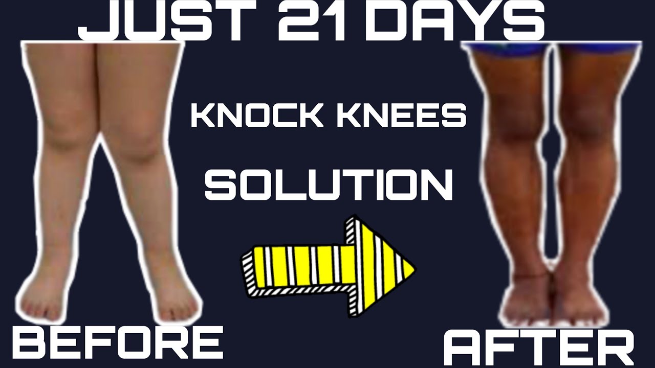 HOW TO SET KNOCK KNEES PROBLEM II KNOCK KNEES KAISE THEEK KAREIN II ANKIT FITNESS YouTube