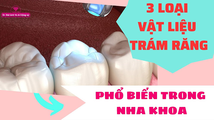 Nhiệt plastification của vật liệu làm răng là gì năm 2024