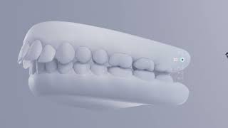 Carriere Motion 3D for Class II Correction with SLX3D Brackets: Doctors Education
