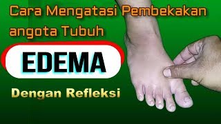 How to Treat Swelling in Feet, Hands, and Arms (Edema) Using Reflexology Techniques screenshot 4