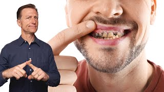 (牙齒4) 什麼溶解牙齒？保健預防蛀牙,柏格醫生 Dr Berg