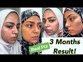 Skincare Routine for Hyperpigmentation & Acne Scars THAT ACTUALLY WORKS!