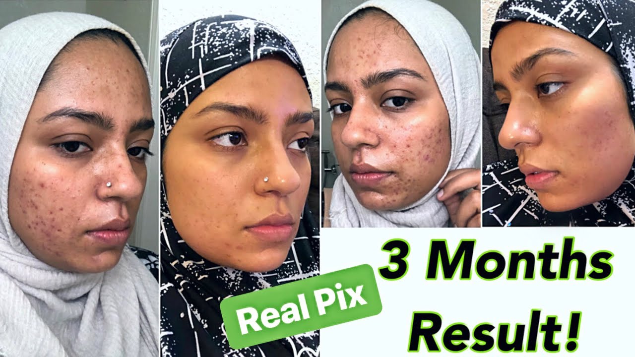 best skin routine for hyperpigmentation