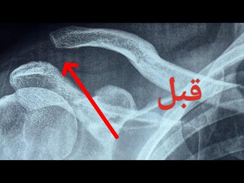 عملية إصلاح خلع مفصل الترقوة