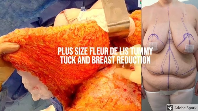 Dr Repta Performs a Plus Size Tummy Tuck 