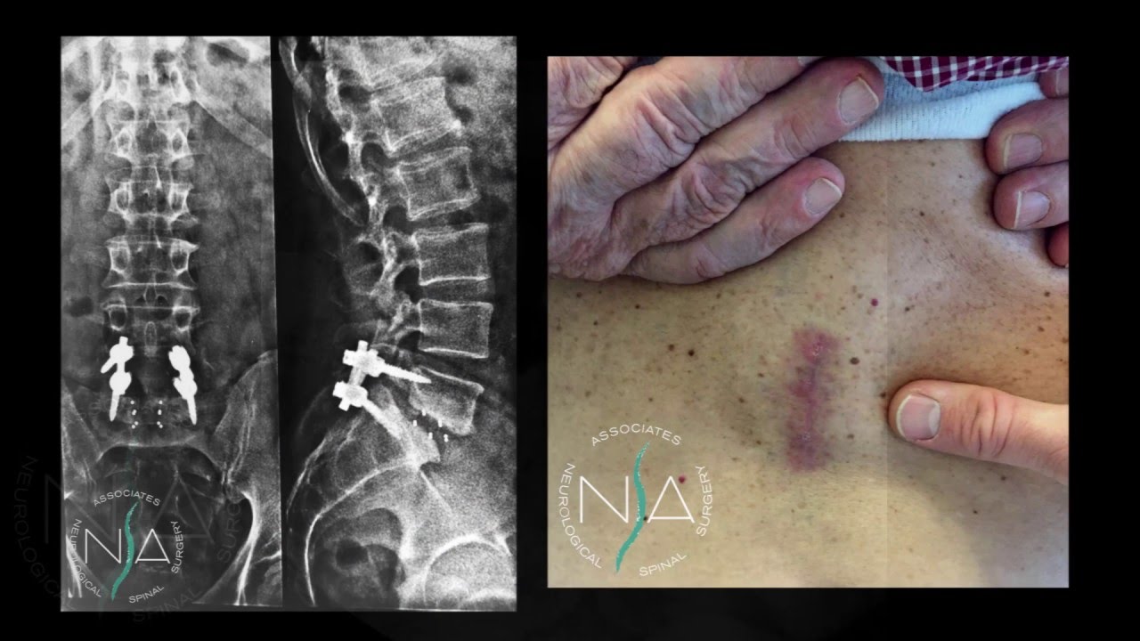 artrodesi l4-l5-s1 e percentuale di invalidità