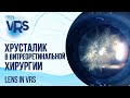 Хрусталик в витреоретинальной хирургии | Lens in vitreoretinal surgery