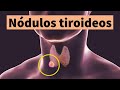 NÓDULOS TIROIDEOS: síntomas, diagnóstico, tratamiento y prevención (bulto o bola en el cuello)