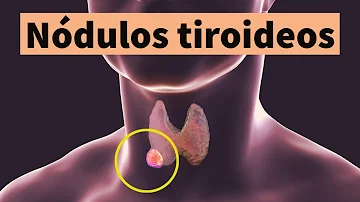 ¿La tiroides agrandada se siente como algo atascado en la garganta?