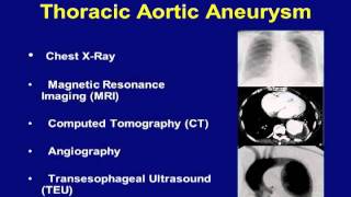 Minimally Invasive Repair of Thoracic Aortic Aneurysm Video  Brigham and Women's Hospital