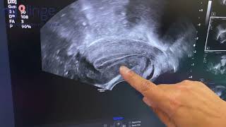 Baarmoederslijmvlies Endometrium Voor De Eisprong