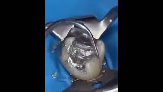 This is how metal fillings are done #dental #lab #dentalprosthesis #crown #dentallab