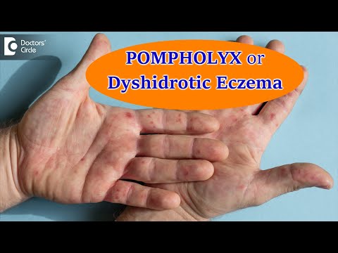Video: Ar vezikulinis rankų dermatitas yra užkrečiamas?