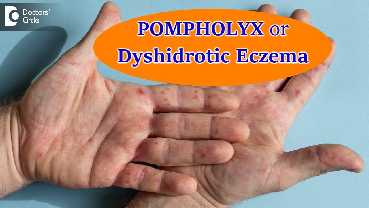DYSHIDROTIC ECZEMA OR POMPHOLYX: Causes,Symptoms, & Treatment - Dr ...