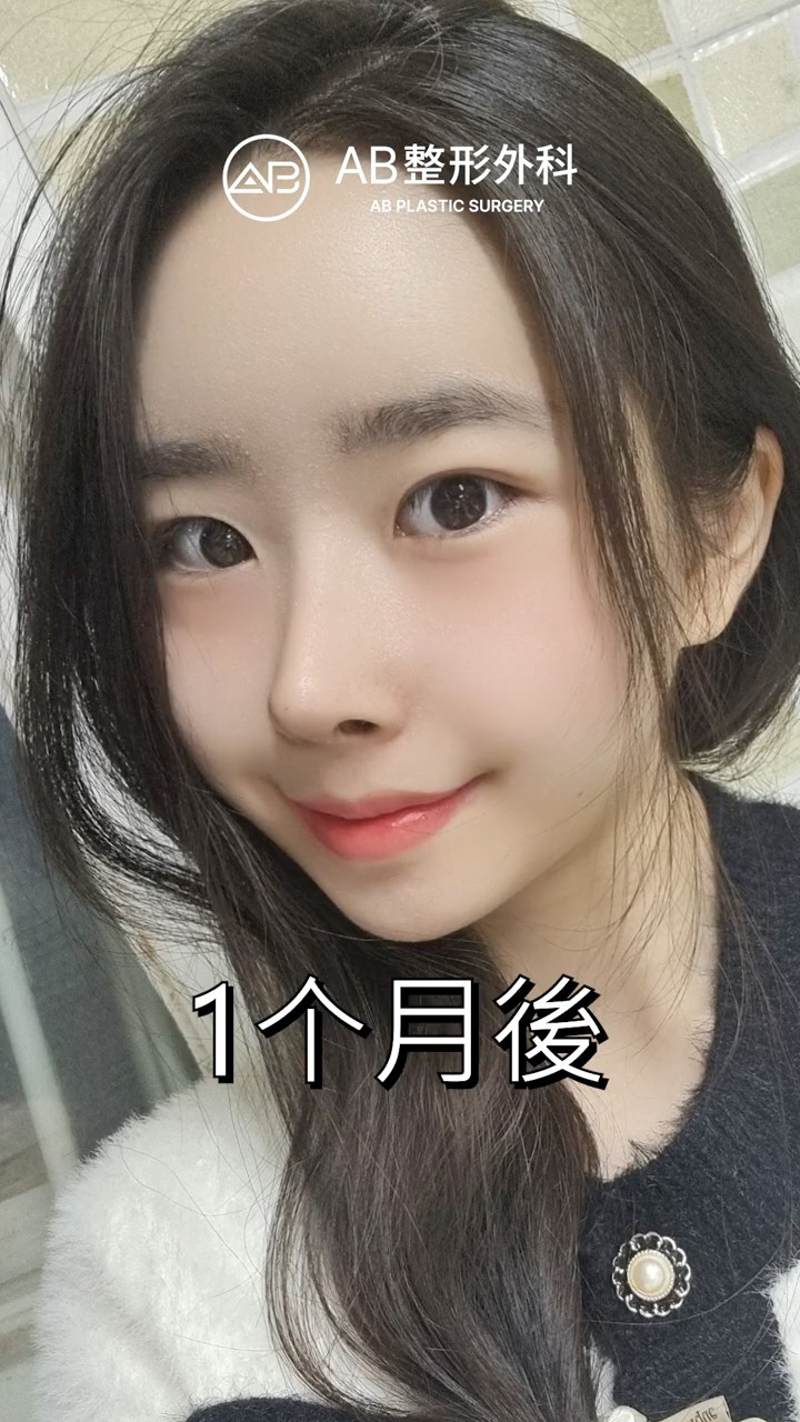 只調整鼻子＋輪廓，三個月後差太多了 #shorts