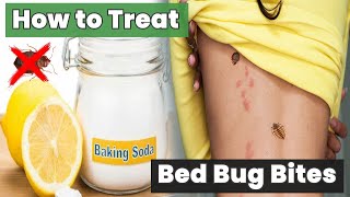 How to Treat Bed Bug Bites at Home – The Secret Doctors Don’t Tell You!