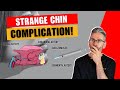 New injection complication affecting men! Chin hair loss after Jaw filler.