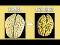 The biggest  reason people get alzheimers disease dementia
