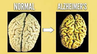 The BIGGEST  reason people get Alzheimer's Disease (DEMENTIA)