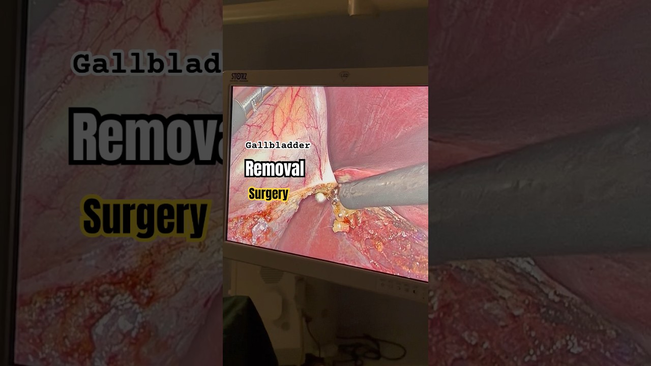 Gallbladder Stones removal Treatment I Operation I Gallstones Surgery