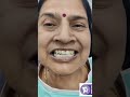 Smile Transformation #dentalartistry #smilecorrection #beautifulsmiles