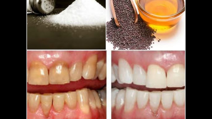 WHITEN TEETH USING MUSTARD OIL AND SALT REMEDY 