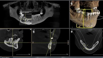 Sirona SL + Sidexis 4 CBCT