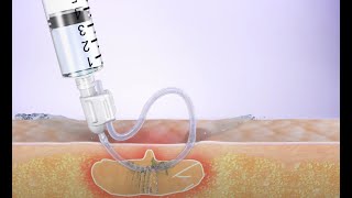 Innovative abscess drainage device - 3D animation