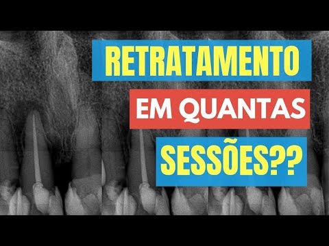 Vídeo: O seguro cobre retratamento do canal radicular?