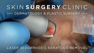 Seborrhoeic Keratosis Removal - See The Treatment