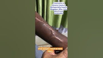 Hand reconstruction surgery