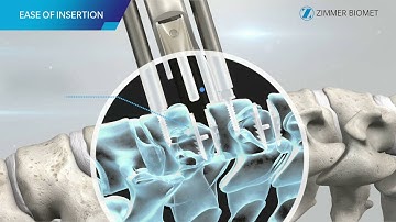 Mobi-C Cervical Disc