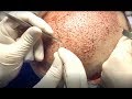 Premier clinic performs fue hair transplant