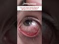Can your eyes reveal signs of aging and heart disease?