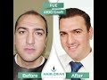 Hair transplant turkey hair of zrian fue 4100 graft