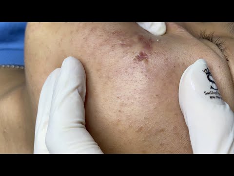 Video Inflammatory Acne P3 (Minh) | Mụn Viêm Tụ Máu P3... - youtube