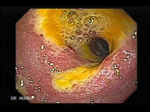 Upper Endoscopy Upper GI Procedure Nebraska Patient Education. 