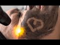 CARBON LASER PEEL ❤️ LOVE YOUR SKIN 💝